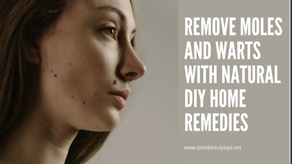 Remove Moles and Warts with Natural DIY Home Remedies