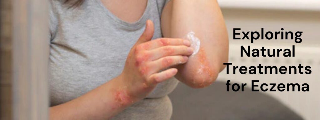 Exploring Natural Treatments for Eczema